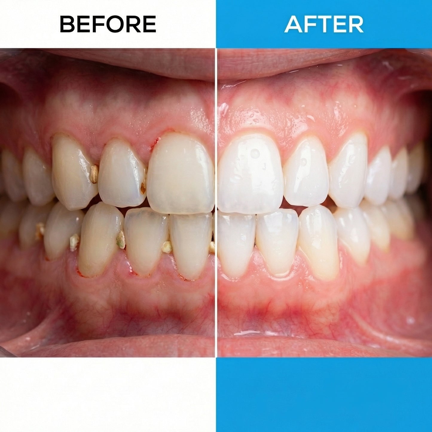 Hygenify™ Dental Water Pressure Flosser